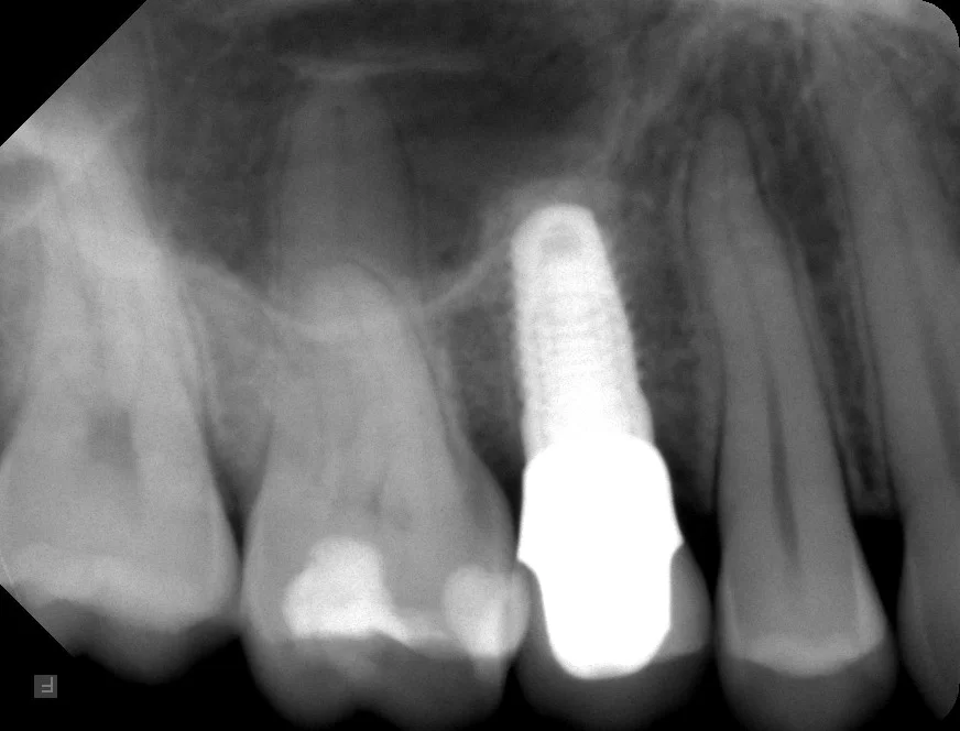 Implantat eines Zahnes als Zahnersatz