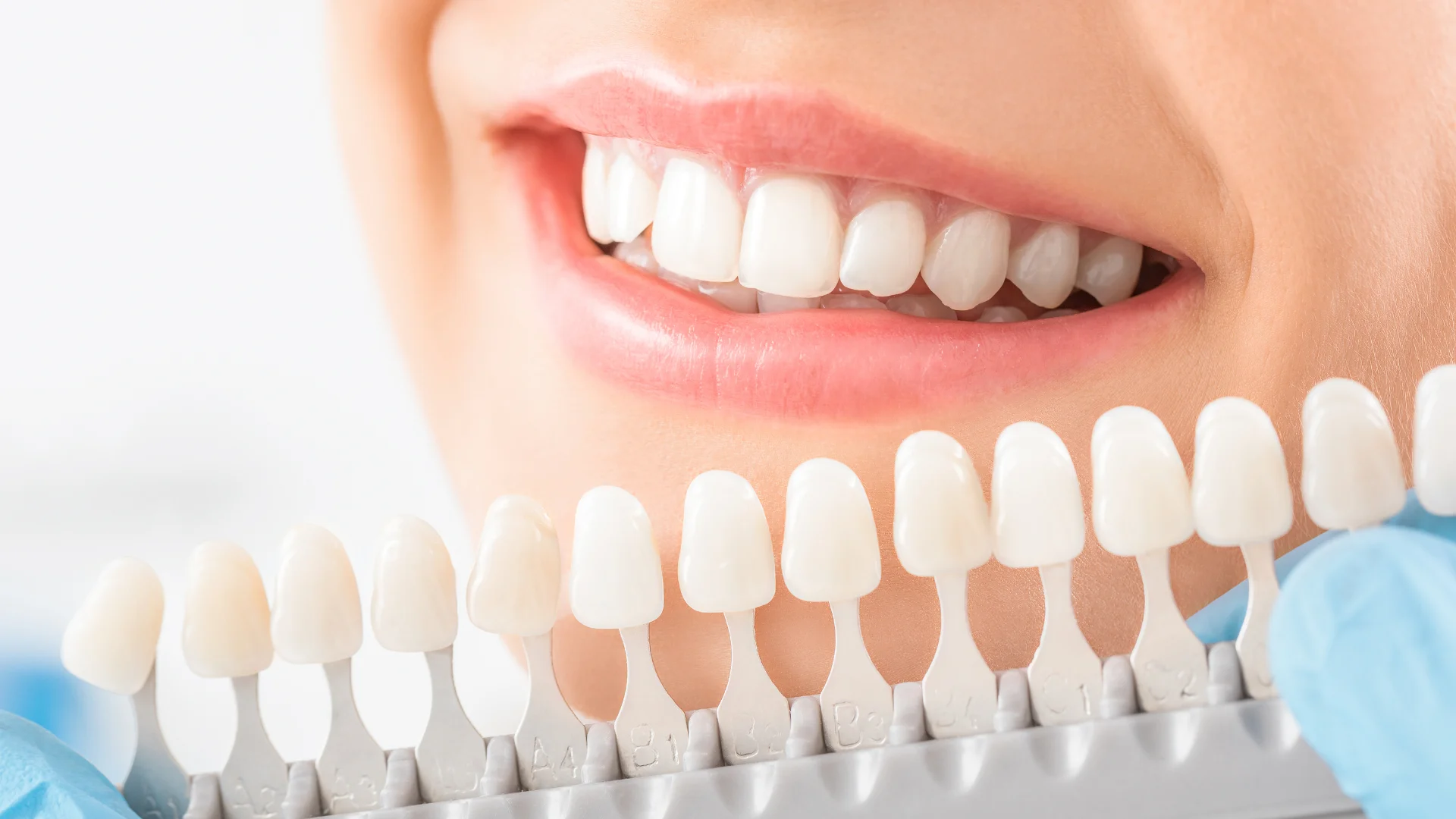 veneers zahnfarben